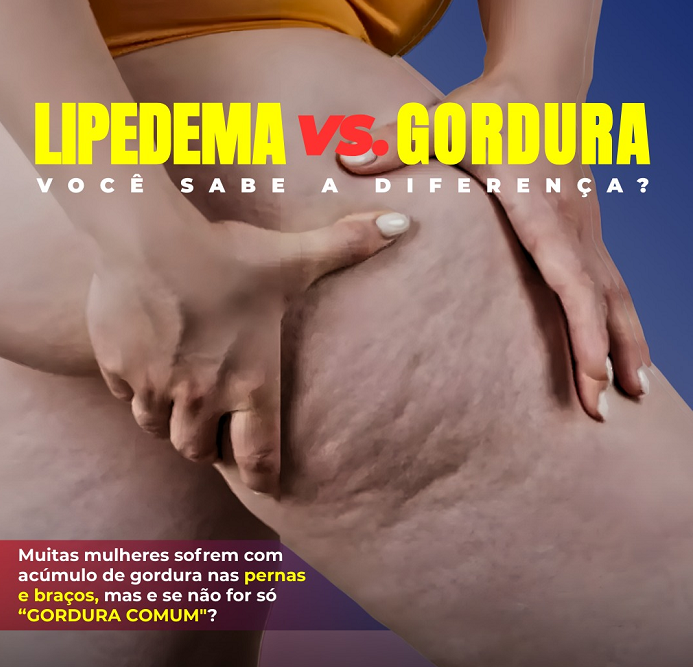 lipedema vs. Gordura Comum: Entenda as Diferenças!