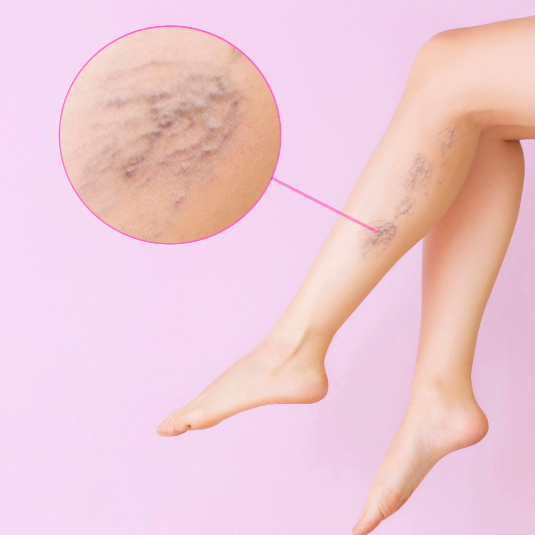 Design Sem Nome 18 Por que Tratar Vasinhos e Varizes com Angiologista e/ou Cirurgião Vascular?